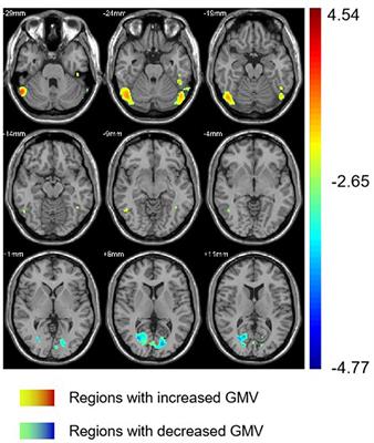 Alteration of Brain Structure With Long-Term Abstinence of Methamphetamine by Voxel-Based Morphometry